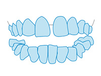 空隙歯列/すきっ歯