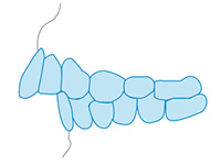 上顎前突/出っ歯
