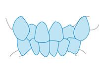 叢生/乱ぐい歯・八重歯