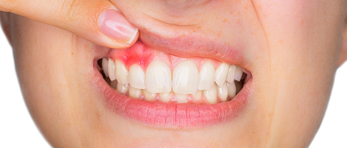 歯周病は成人の80%が予備軍と言われています