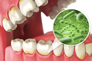 歯周病の原因と症状
